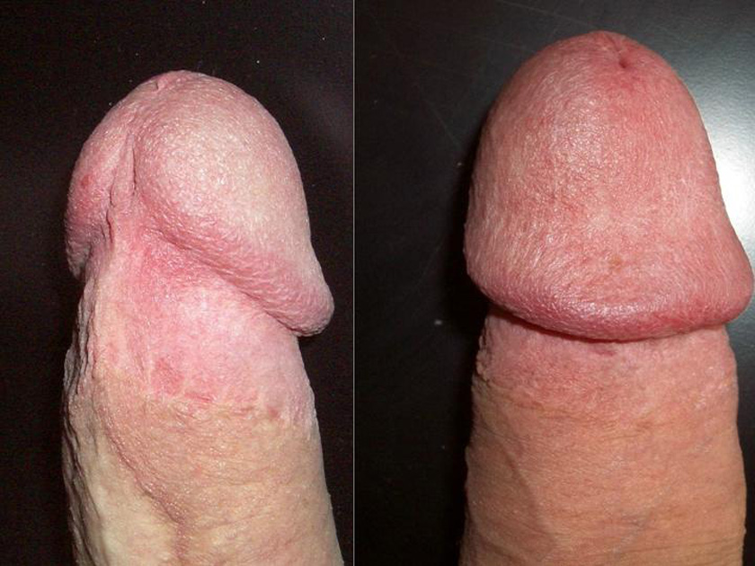 Uncircumcised penis problems short frenulum.